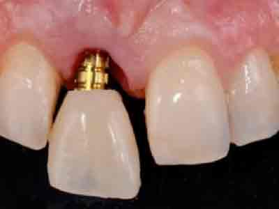 Tratamiento de implantes dentales