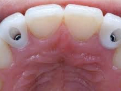 Clinica de encias Garcia Urria Implantes