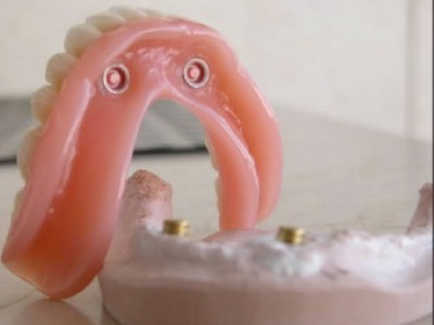 foto Prótesis de sobredentadura con 2 Implantes