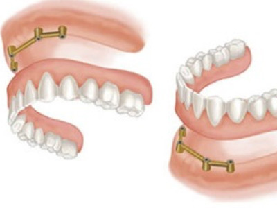 Prótesis de sobredetadura con 3 o 4 Implantes