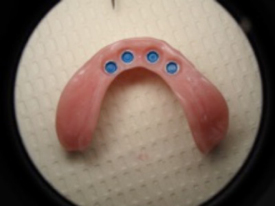 programa de implantes dentales