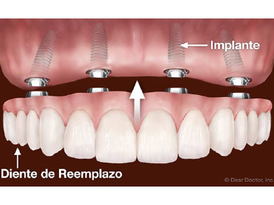 Mejorar Sobredentadura a Puente Fijo con 3 implantes