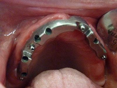 Prótesis Híbrida o Fija sobre 6 implantes