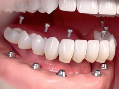 Híbrida o Fija con 6 implantes más Cosmética