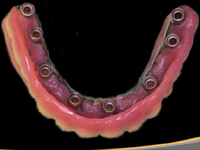 Programa de implantes Prótesis Híbrida Fija con 8 implantes