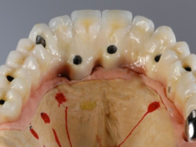 Carga Inmediata 8 Implantes y Cerámica Definitiva