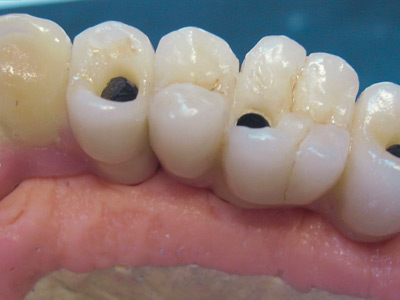 Clinica de encías 8 Implantes