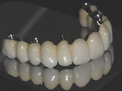 Foto Carga Inmediata 8 Implantes y Cerámica Definitiva