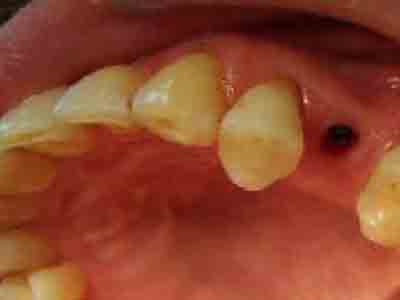 programa de tratamiento de implantes