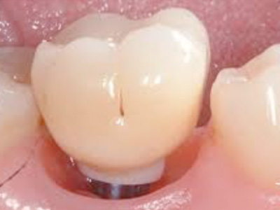 Programa de Implantes Clinica de Encías GU