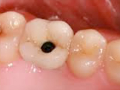 Tratamiento de implantes Clínica de Encías