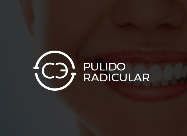 Pulido Radicular 